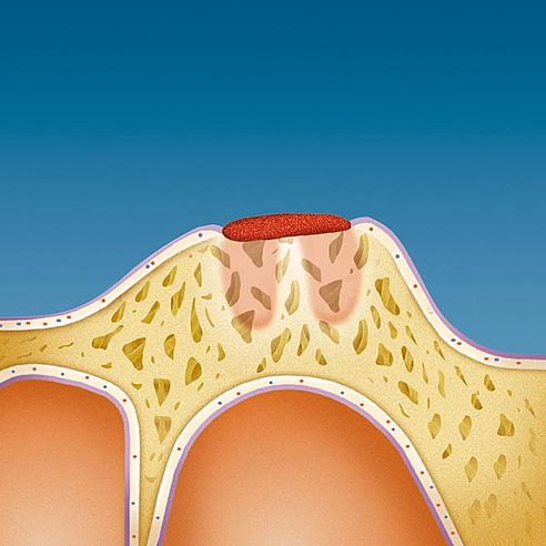 Wound covered by a protective mucous membrane | Protefix