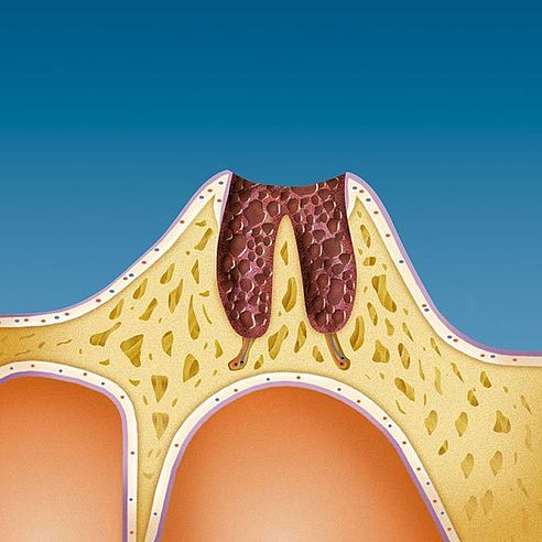 Het gevolg van het verliezen van een tand is een diepe wonde in je kaak | Protefix